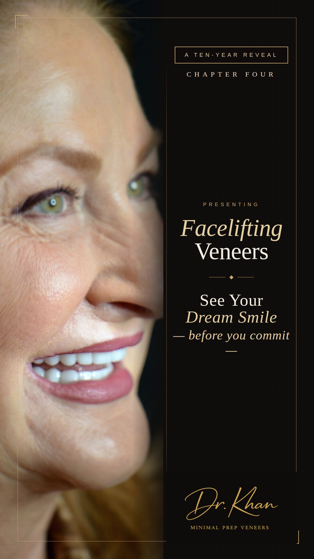 Facelifting Veneers by Dr. Khan — see your dream smile before you commit