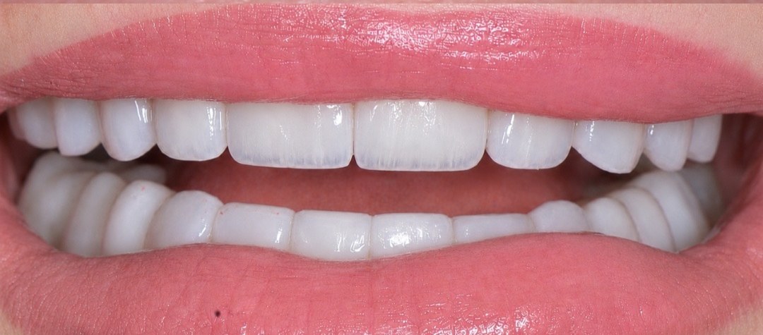 Smile after treatment by Dr. Khan