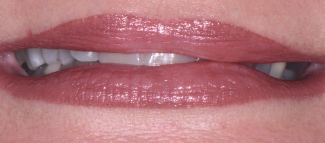 Smile before treatment