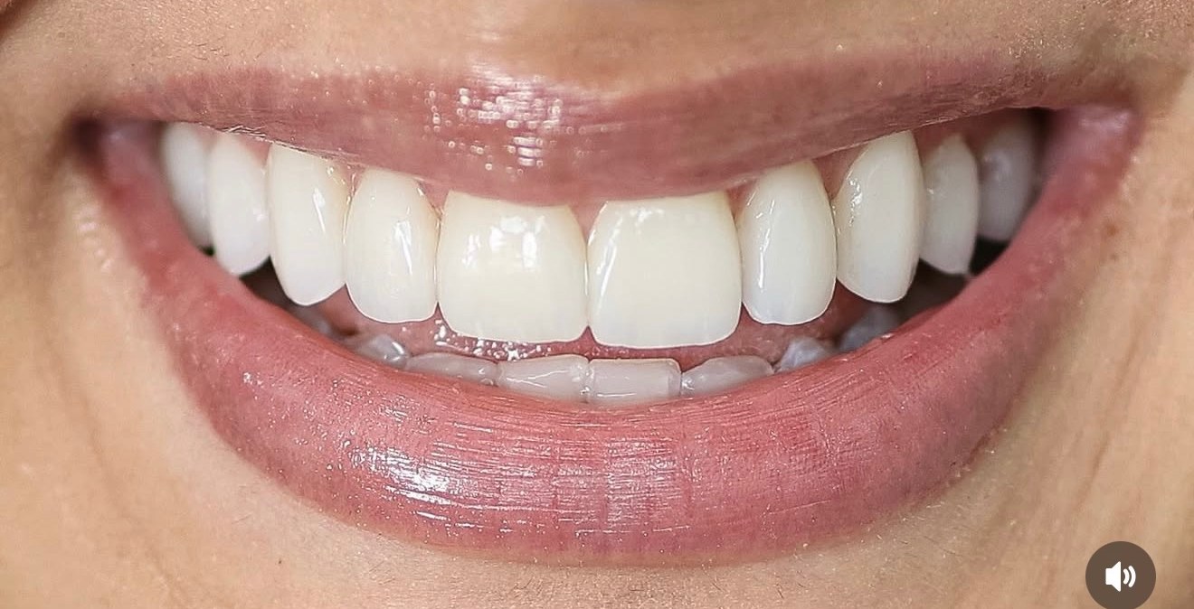 Smile after treatment by Dr. Khan